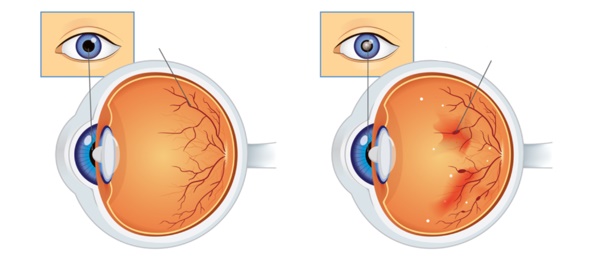 Delwedd yn cymharu llygad iach arferol ag un sydd â niwed i’r retina a phibellau gwaed yn gollwng.