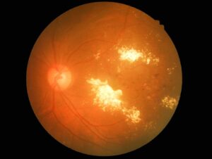 A retinal photograph showing bright yellow‑white deposits clustered around the central retina, with smaller scattered spots nearby. The optic disc on the left appears bright, and the background shows the usual orange-red retinal surface and blood vessels.