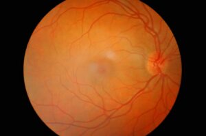 A retinal photograph showing a healthy eye. The optic disc appears clear and well‑defined on the right side, with normal branching blood vessels extending across the orange-red background of the retina.