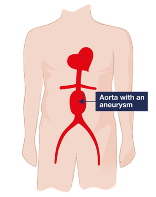 llustration of a human body highlighting the abdominal region, with an arrow pointing to the aorta showing a bulging section, indicating an abdominal aortic aneurysm (AAA).