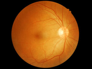 Llun o'r retinol yn dangos newidiadau cefndir cynnar. Mae dotiau coch bach i’w gweld ar draws y retina, sy’n cynrychioli mannau bach lle mae pibellau gwaed wedi gollwng.