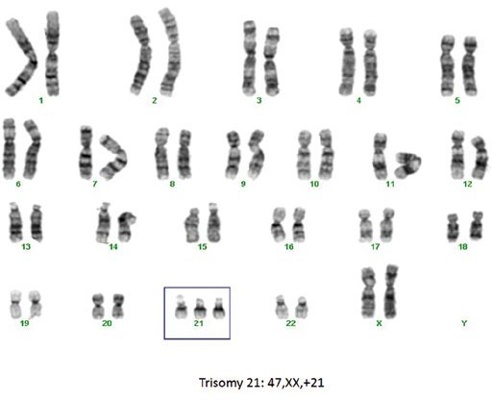 Image showing a set of chromosomes from a baby’s cells viewed under a microscope. The chromosomes are arranged in pairs, with a box highlighting three copies of chromosome 21 instead of the usual two, which causes Down’s syndrome.